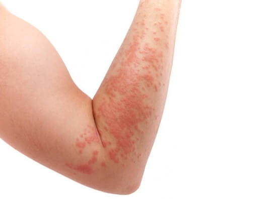 Vrste dermatitisa – atopijski dermatitis – je li zarazan?