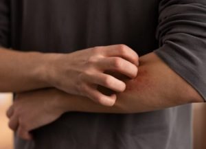 Psorijaza - što je uzrokuje